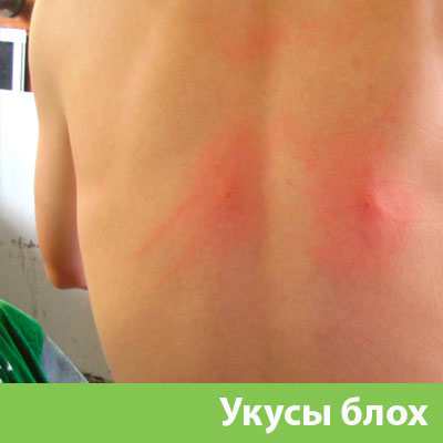 Укусы блох в Чапаевске