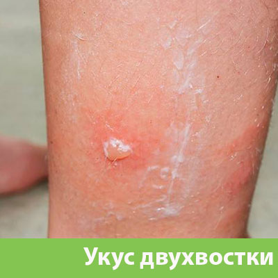 Укус двухвостки в Чапаевске