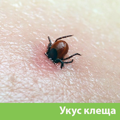 Укус клеща в Чапаевске