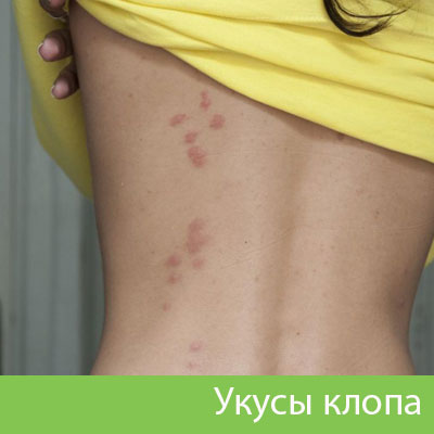 Профессиональное уничтожение клопов в Чапаевске